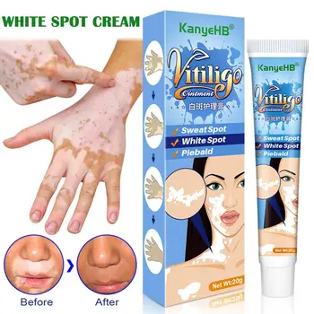 Bitkisel Özü Vitiligo Merhem Kaldırmak Saçkıran Beyaz Krem Onarım Cilt Beyaz Nokta Lökoplaki Hastalığı Tedavisi Nokta Remo C1N6